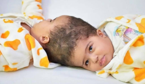 The surgical separation was carried out by a 36-member medical team, headed by King Salman Humanitarian Aid and Relief Centre Supervisor General Dr. Abdullah Al-Rabeeah.
