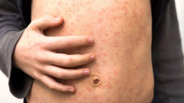 Health experts warn that measles spreads very easily and can lead to some children suffering life-long consequences