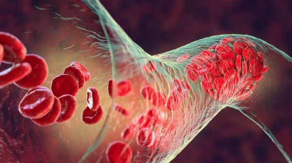 SFDA approves 'Winrevair' for rare pulmonary hypertension treatment